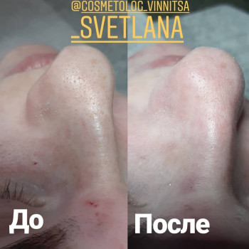 Чистка лица
                    Мастер перманентного макияжа Светлана Винница