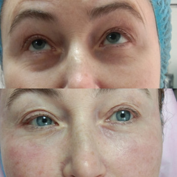 Контурная пластика лица
                    Косметолог-ін'єкціоніст Виктория Полтава