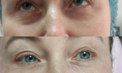 Контурная пластика лица Косметолог-ін'єкціоніст Виктория Харків