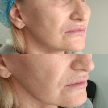 Контурная пластика лица
                    Косметолог-ін'єкціоніст Виктория Полтава