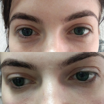 Контурная пластика лица
                    Косметолог-ін'єкціоніст Виктория Полтава