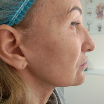 Контурная пластика лица
                    Косметолог-ін'єкціоніст Виктория Полтава