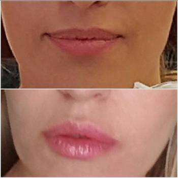 Контурная пластика губ