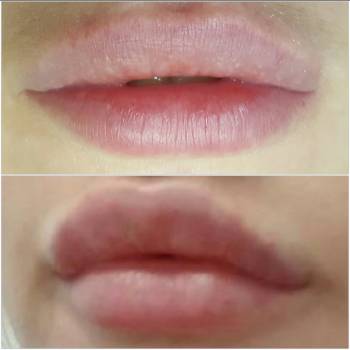 Контурная пластика губ