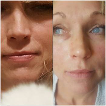 Применение сочетанных методик Пилинг срелинный курс иезотер