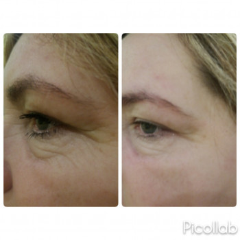   
Коррекция орбитальной зоны
48 лет 
до и сразу после