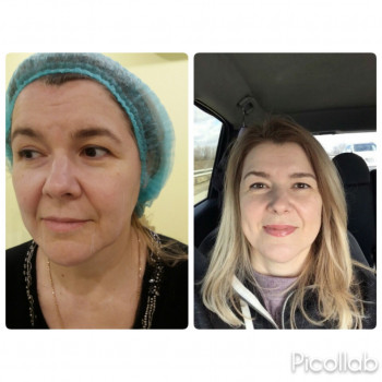   
47 лет, 
до и через 10 дней