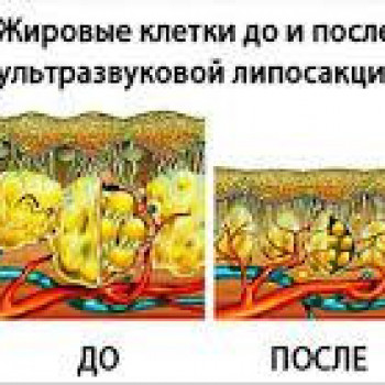 Результаты до и после кавитации