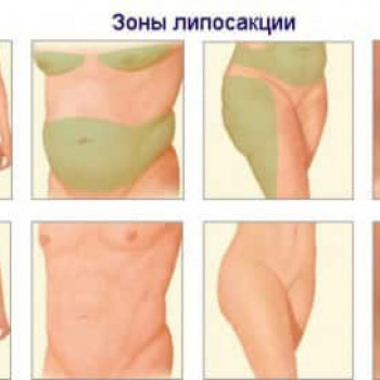 Зоны липосакции 