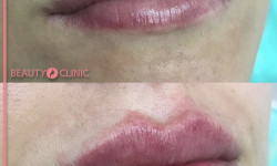 Увеличение губ Juvederm Ultra 3 Медичний центр Beauty Clinic Київ