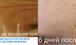 Ботулінотерапія Косметолог-ін'єкціоніст Светлана Суми