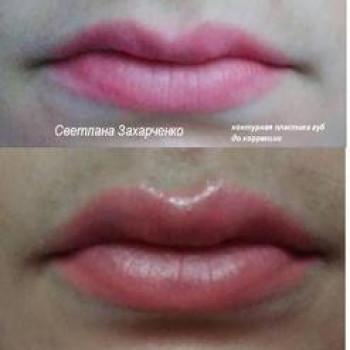 Контурна пластика філерами на основі гіалуронової кислоти
                    Косметолог-инъекционист Светлана Сумы