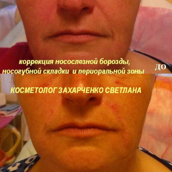 Контурна пластика філерами на основі гіалуронової кислоти
                    Косметолог-инъекционист Светлана Сумы