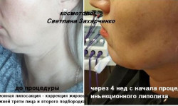 Безопераційна ліпосакція/Ферментотерапія Косметолог-ін'єкціоніст Светлана Суми