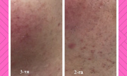 Лазерна епіляція діодним лазером, Лазерна елос епіляція Косметологічний центр Лазердей (Lazerday) Львів