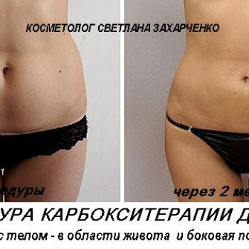 Процедура карбокситерапії для тіла