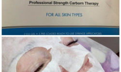 Карбокситерапия Врач-косметолог Алина Киев