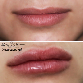 Увеличение губ
                    Косметолог Любовь Бандура Харьков