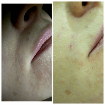 Биоревитализация
                    Врач-косметолог Алина Киев