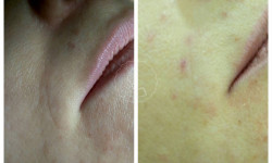 Биоревитализация Лікар-косметолог Алина Київ