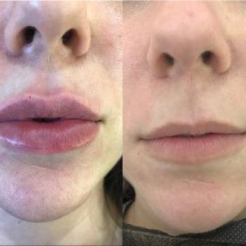 Увеличение губ