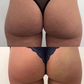 Устранение локальных жировых отложений