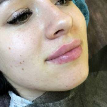 Увеличение губ