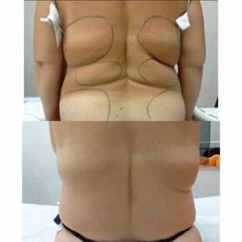 Устранение локальных жировых отложений