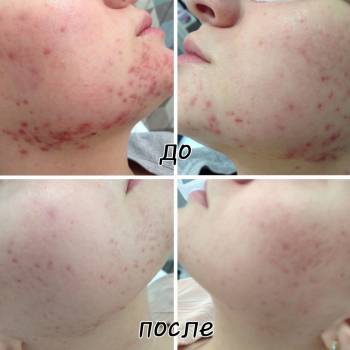 Лечение акне