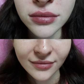 Увеличение губ