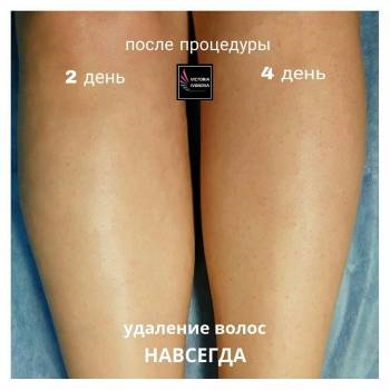 Процесс заживления после процедуры Электроэпиляции