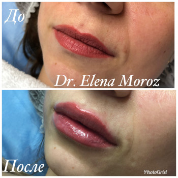 Увеличение губ. Юведерм 1 мл