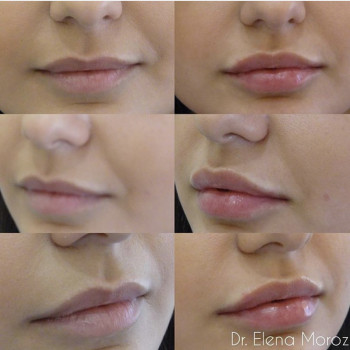 Увеличение губ Юведерм 