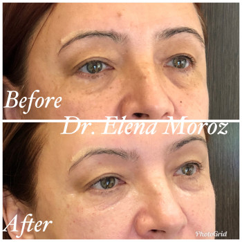 Коррекция мешков под глазами и темных кругов