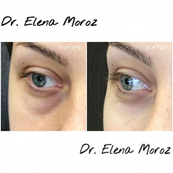 Коррекция мешков под глазами и темных кругов 