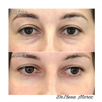 Коррекция мешков под глазами и темных кругов 