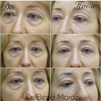 Коррекция мешков под глазами и темных кругов 