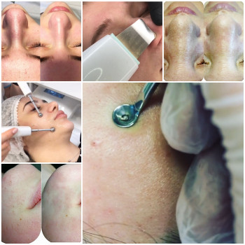 Чистка кожи "Все включено" с аппаратным восстановлением баланса кожи
                    Косметолог Ирина Київ