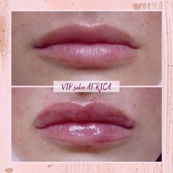 контурная пластика губ: Princess Filler Lidocaine 1 ml