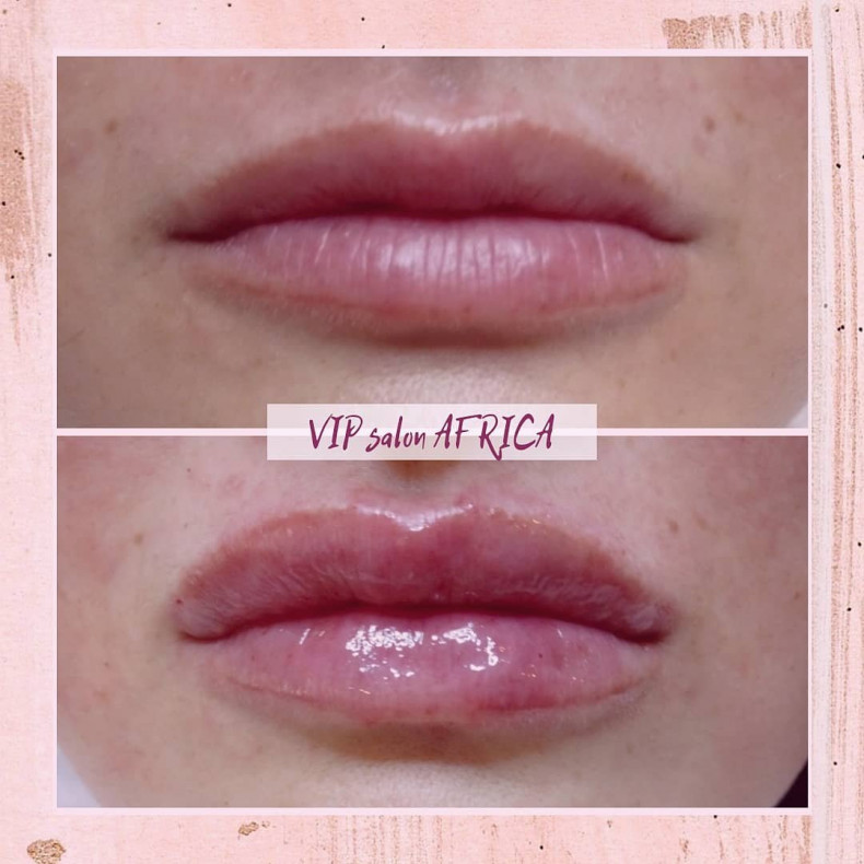 Контурная пластика губ: Princess Filler Lidocaine 1 ml, фото -  