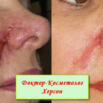 Некроз кожи со вторичной инфекцией после контурной пластики 