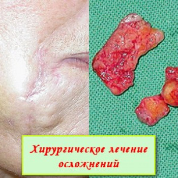 Крупное образование из мигрировавшего акрилового геля, введе