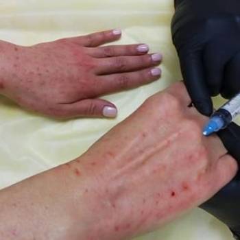 Витаминотерапия тыльной части рук
Препаратом на основе колл