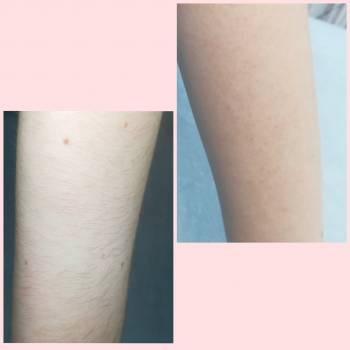 Шугаринг рук 