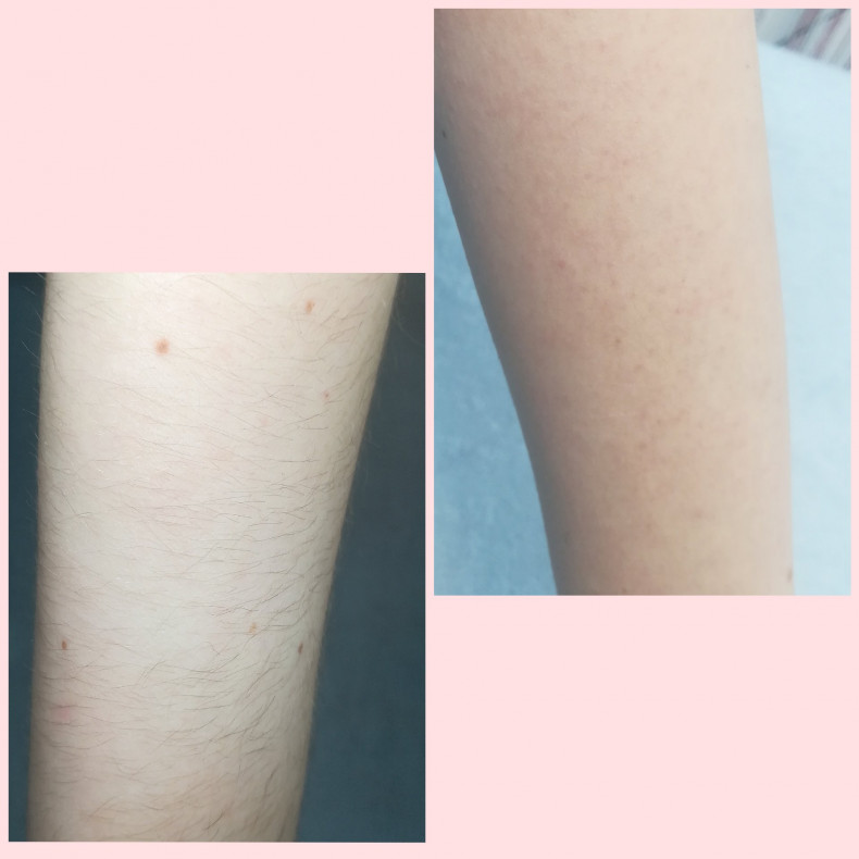 Шугаринг рук , фото - Салон красоты La Belle