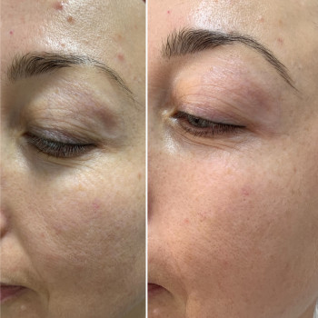 БМС (Массаж лица)
                    Трихолог Анна Житомир