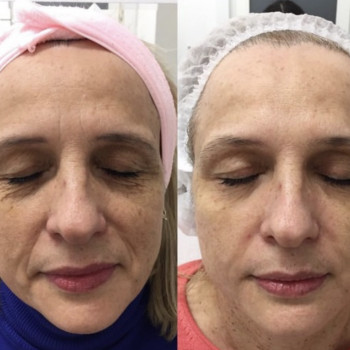 БМС (Массаж лица)
                    Трихолог Анна Житомир