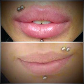 Увеличение губ