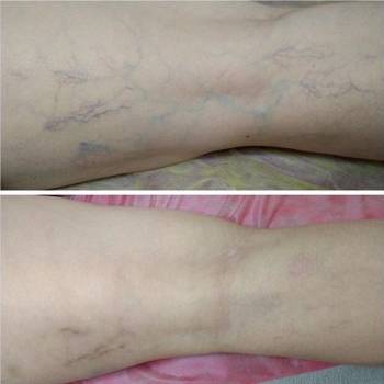 Удаление венозной сетки