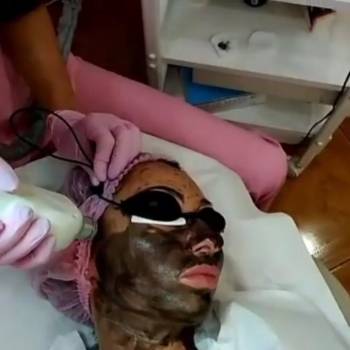 Карбоновый пилинг